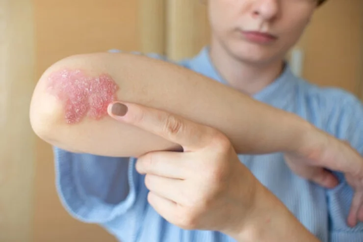 psoriasis